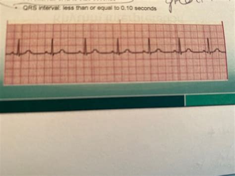 Arrhythmia Test Flashcards Quizlet