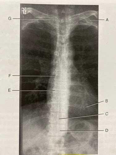 T Spine Radiographs Flashcards Quizlet