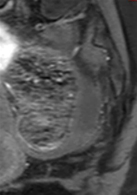 IRM abdominale inférieure 3T coupes sagittales en pondération T1