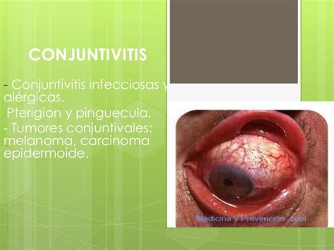 Conjuntivitis Viral