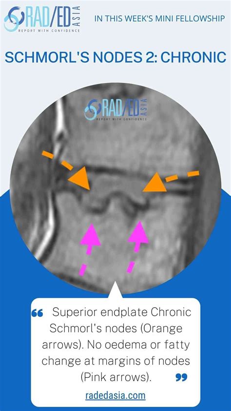 SCHMORL S NODES SPINE MRI ONLINE RADIOLOGY COURSE LEARN KEY POINTS