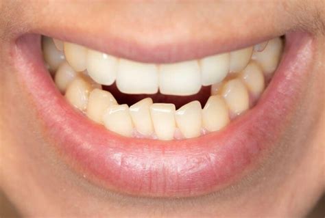 Options For Fixing Crooked Bottom Teeth