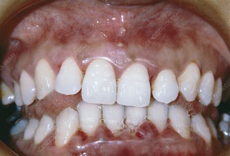 Gingivitis Stock Image M782 0180 Science Photo Library