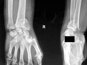 fig 6 displaced fracture