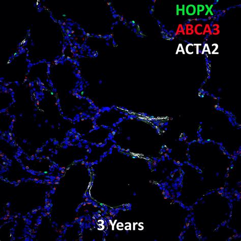 3 Year Human Lung HOPX ABCA3 And ACTA2 Confocal Imaging