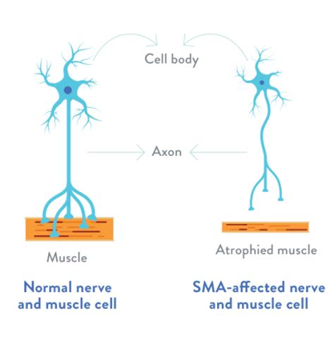 Atrofi Otot Spinal Penyebab Gejala Penanganan Pencegahan Dan Dokter