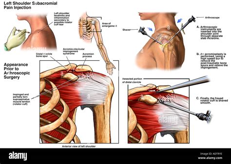 Left Shoulder Arthroscopic Subacromial Decompression Surgery Stock