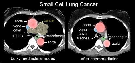 Xrays and CT Scans of Lung Cancer