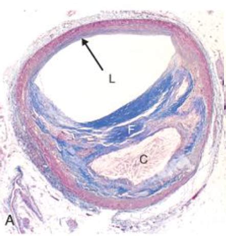 CVS Pathology 1 Ischemic Heart Disease IHD Flashcards Quizlet