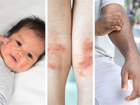 Qanda Treatment Of Moderate To Severe Atopic Dermatitis In Adult