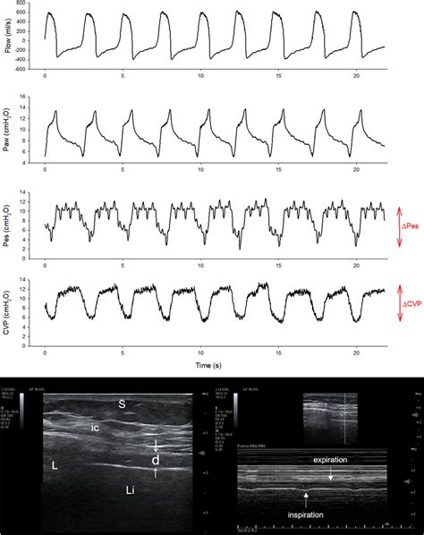 Inspiratory Effort Measurements In A Representative Patient The Upper