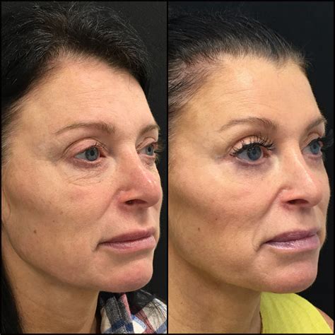 Lower Blepharoplasty Before After Photos Flora Levin Md