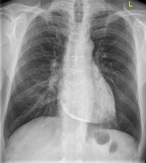 Pericardial Calcification Radiology Case