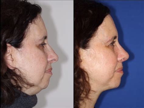 Neck Rejuvenation And Submental Liposuction New York City Dr Dara