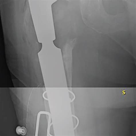 Anteroposterior X Ray Of The Right Hip After Reimplantation With