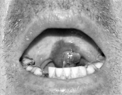 Uvula Haematoma Following Streptokinase And Anti Platelet Therapy