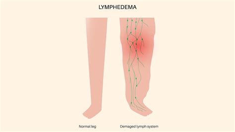 Navigating Life With Lymphedema Understanding Its Causes Symptoms