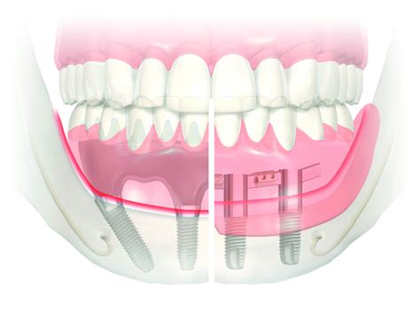 Proth Se Compl Te Et Partielle Amovible Sur Barre Prosthodontiste Qu Bec