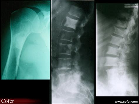 M Tastases Osseuses Condensantes Diapoth Que Du Cofer