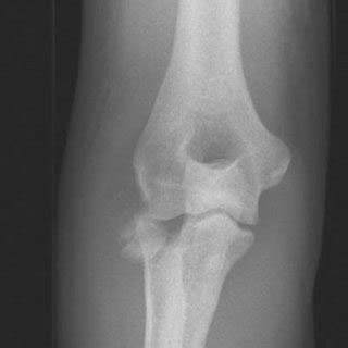 Lateral Radiograph Of A Right Elbow With A Mason Type II Fracture