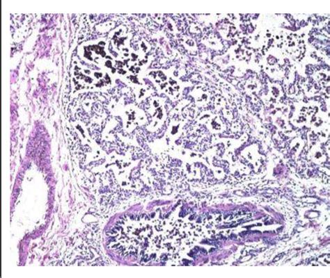 Figure 2 From Primary Pulmonary Hemosiderosis A Rare Cuase Of Microcytic Hypochromic Anemia