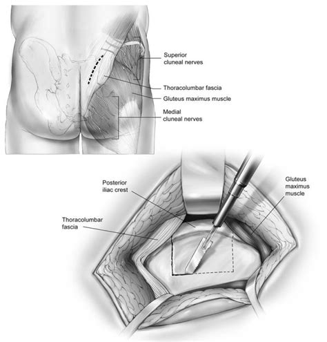 Iliac Crest Bone Harvest Dr Paul Mirdamadi Dds