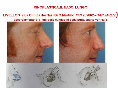 RINOPLASTICA CORREZIONE DEL NASO LUNGO Come Accorciarlo