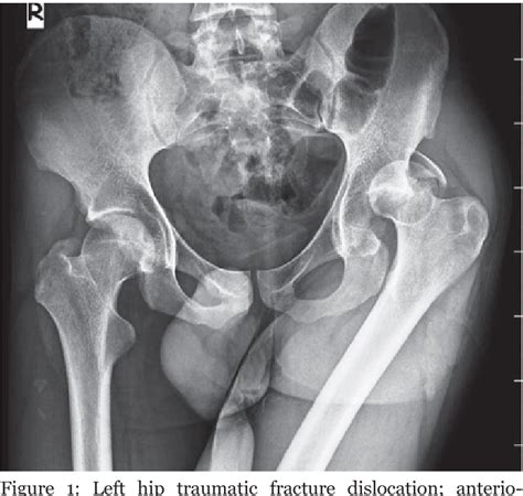 Figure 1 From Traumatic Posterior Hip Instability And Reconstruction