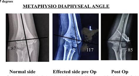 Figure From Surgical Correction Of Post Traumatic Cubitus Varus