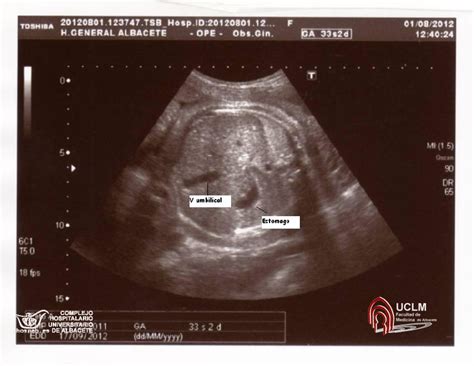 BIOMETRÍA II Circunferencia Abdominal