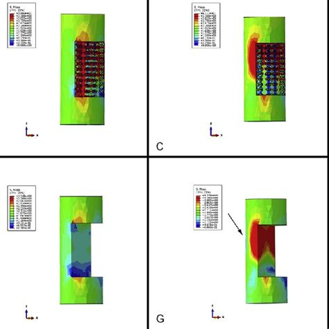 The Stress Shielding Result Of FE Simulation The General Views Of The