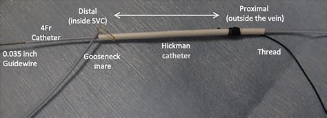 Image showing the set‐up of the Hickman catheter system. A 4‐F catheter ...