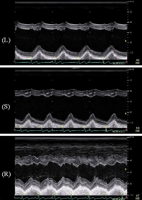 Figure M Mode Echocardiograms Of The Left Ventricle In The Left