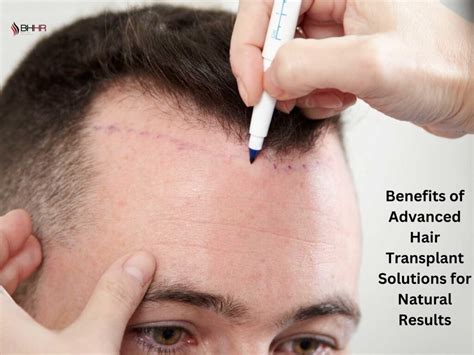 Benefits Of Advanced Hair Transplant Solutions For Natural Results