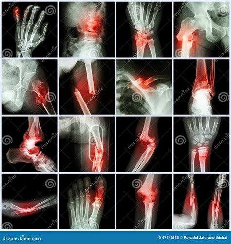 Fratura De Osso Múltipla Do Raio X Da Coleção Imagem De Stock Imagem De Doutor Raio 47646135