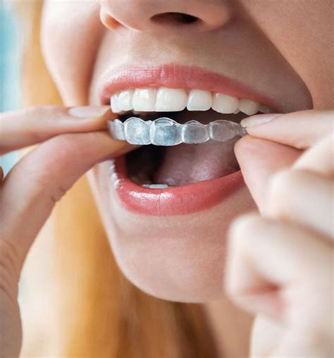 Invisalign En Pasos C Mo Ser Tu Tratamiento Imaxilodental