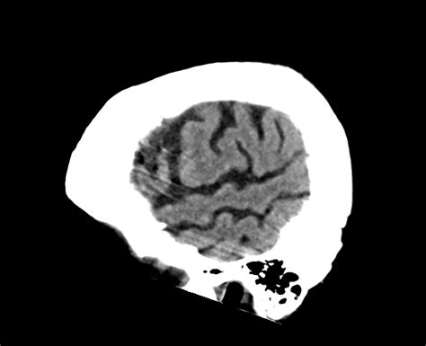 Fileacute Right Mca Infarct Meningioma And Retinal Detachment Ct