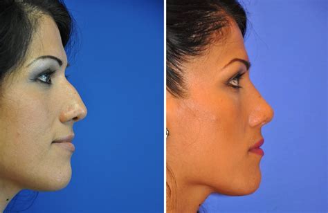 Rhinoplasty Austin Tx Dr Weinfeld