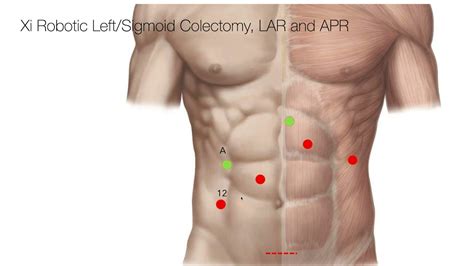 Trocar Placement Robotic Left Sigmoid Colectomy Youtube