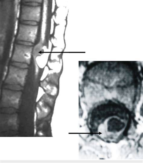 Left Sagittal T Weighted Magnetic Resonance Imaging Of The Patient