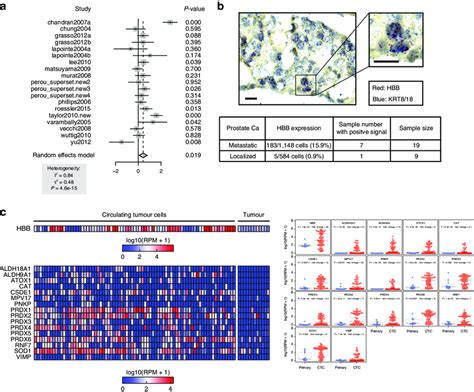 Roles Of Hbb And Other Anti Oxidants In Ctcs And Metastasis A