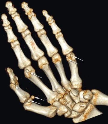 Sesamoid Bone Hand