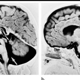 A B Two Contiguous Transverse T2 Weighted Fast Spin Echo MR Images