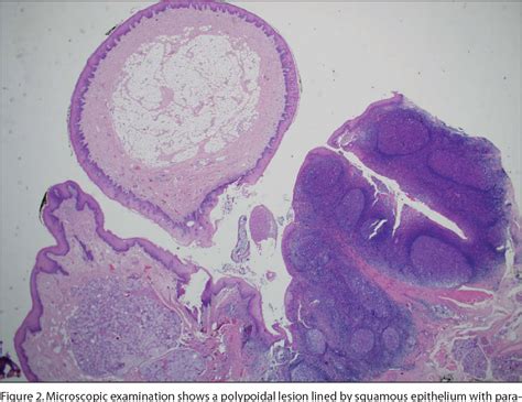 Fibroepithelial Polyp Histology