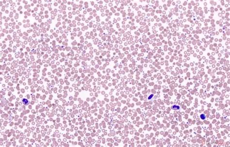 Polycythaemia Vera Learnhaem Haematology Made Simple