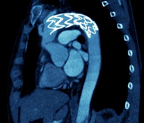 Stent In A Dissecting Aorta 2 Photograph By Zephyrscience Photo Library Fine Art America