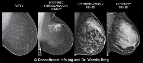 What Is Density In The Breast Connecticut Breast Imaging