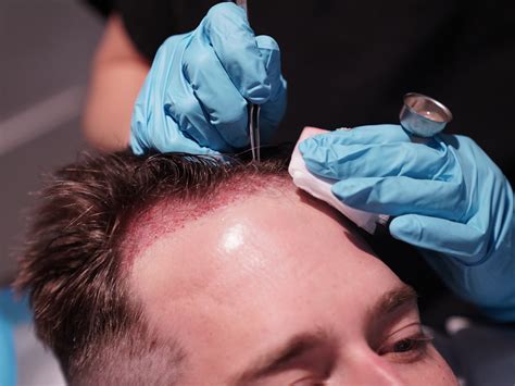 How Does Hair Transplantation Actually Work Northwestern Hair