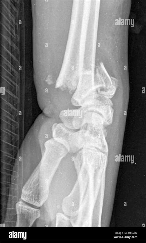 Colles fracture, X-ray Stock Photo - Alamy