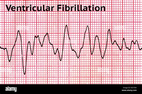 Ventricular Fibrillation Ecg Monitor